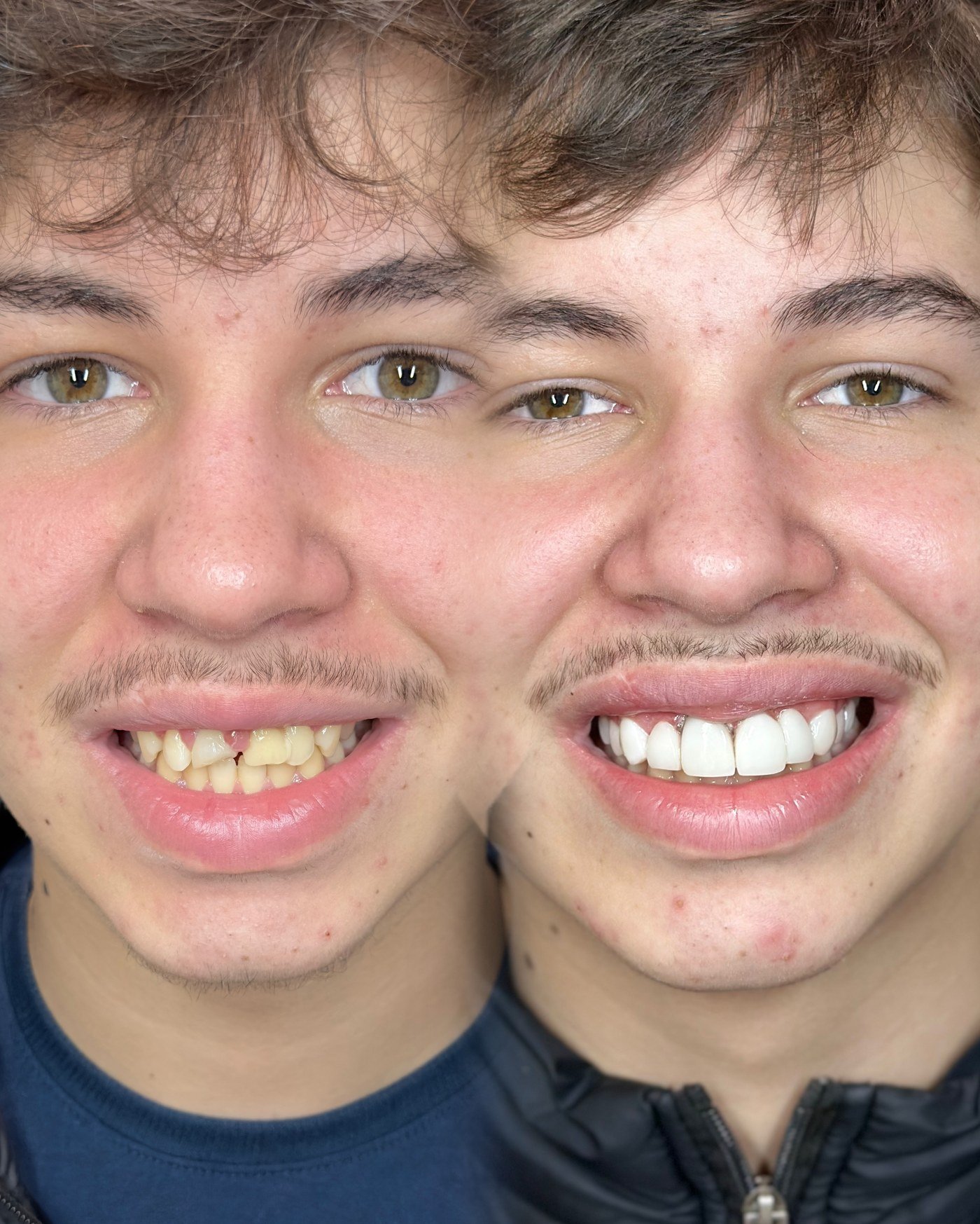 Caso real de transformação completa do sorriso com lentes em resina