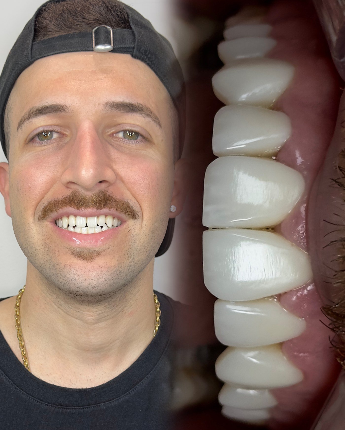 Caso real de design de sorriso com lentes em resina