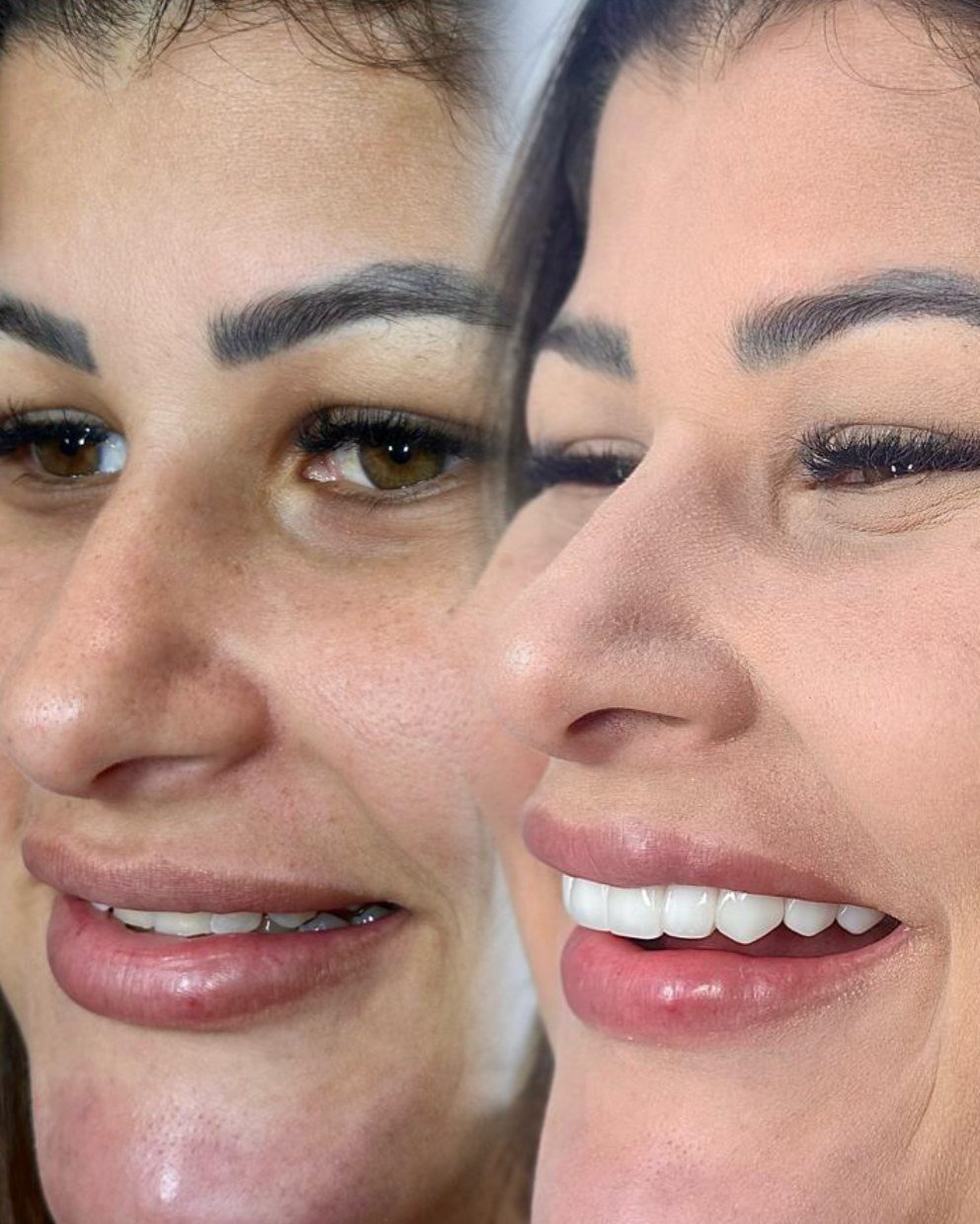 Caso real de harmonização do sorriso com lentes em resina